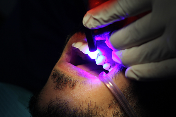 How Dental Bonding Can Minimize Gaps Between Teeth